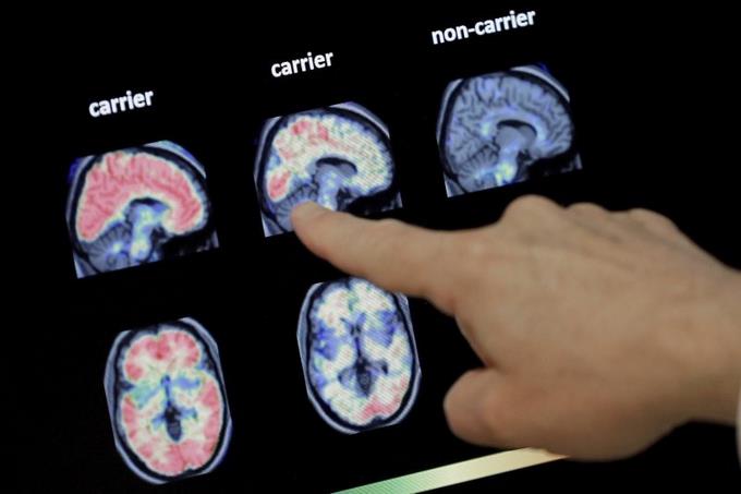  Fármaco es una esperanza ante el Alzheimer